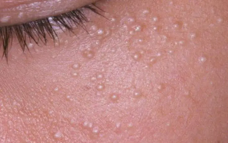 Pulizia della pelle: tutto ciò che devi sapere prima di farlo